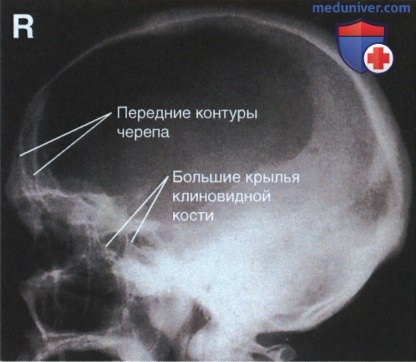 Рентгенограмма лицевого отдела черепа, придаточных пазух и костей носа в боковой проекции