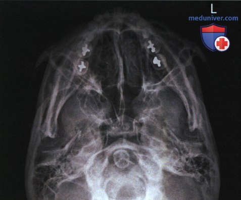 Укладка при рентгенограмме лицевого отдела черепа, придаточных пазух в подподбородочно-верхушечной проекции по методу Шюллера