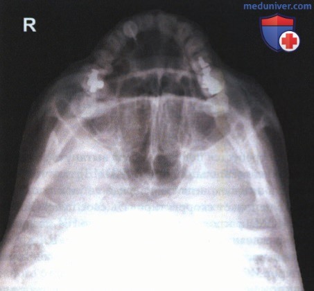Рентгенограмма лицевого отдела черепа, придаточных пазух в подподбородочно-верхушечной проекции по методу Шюллера