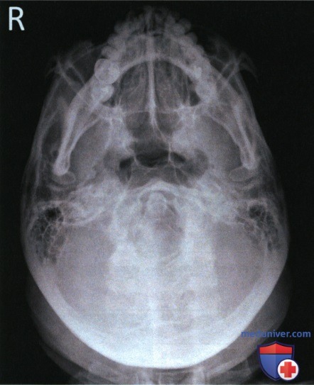 Рентгенограмма лицевого отдела черепа, придаточных пазух в подподбородочно-верхушечной проекции по методу Шюллера