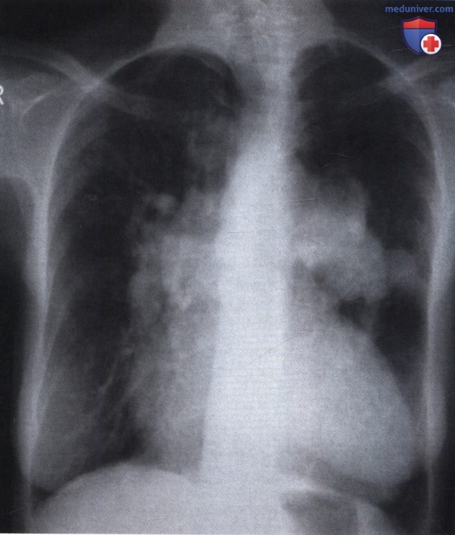 Рентгеновский снимок с патологией корней легких при пороке сердца