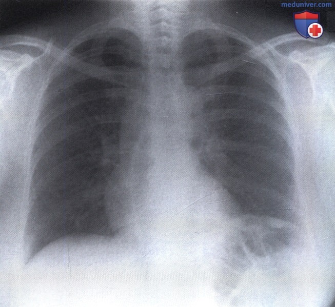 Рентгенограмма с тенью расширенного пищевода