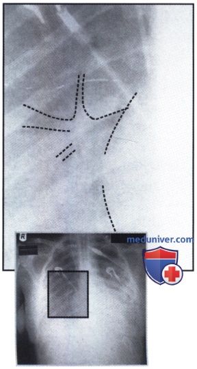 Рентгенограмма с затемнением обоих легочных полей при внутрибольничной пневмонии