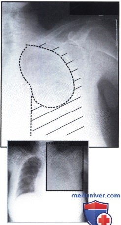 Рентгеновский снимок с затемнением левого легкого при эксудативном плеврите