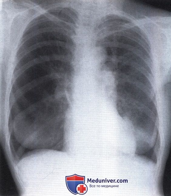 Рентгенограмма со светлыми нижними отделами легочных полей при эмфиземе