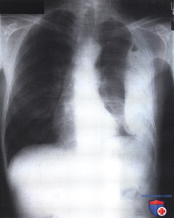Рентгеновский снимок с областью интенсивного затемнения у латерального края легкого при эмпиеме