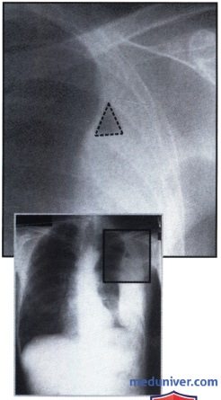 Рентгеновский снимок с областью интенсивного затемнения у латерального края легкого при эмпиеме