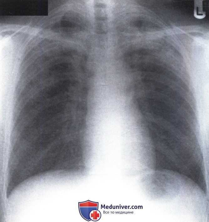 Рентгенограмма с затемнением в области верхушек легких с обеих сторон при эозинофильной пневмонии