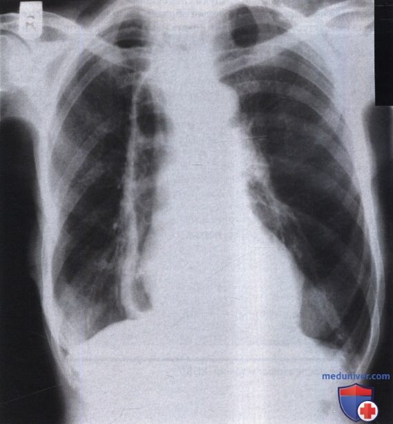 Рентгенограмма с патологической тенью линейной формы справа от средостения после эзофагэктомии