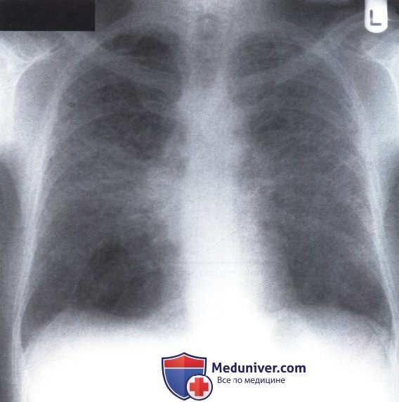 Рентгенограмма с затемнением обоих легочных полей при фиброзе из-за саркоидоза