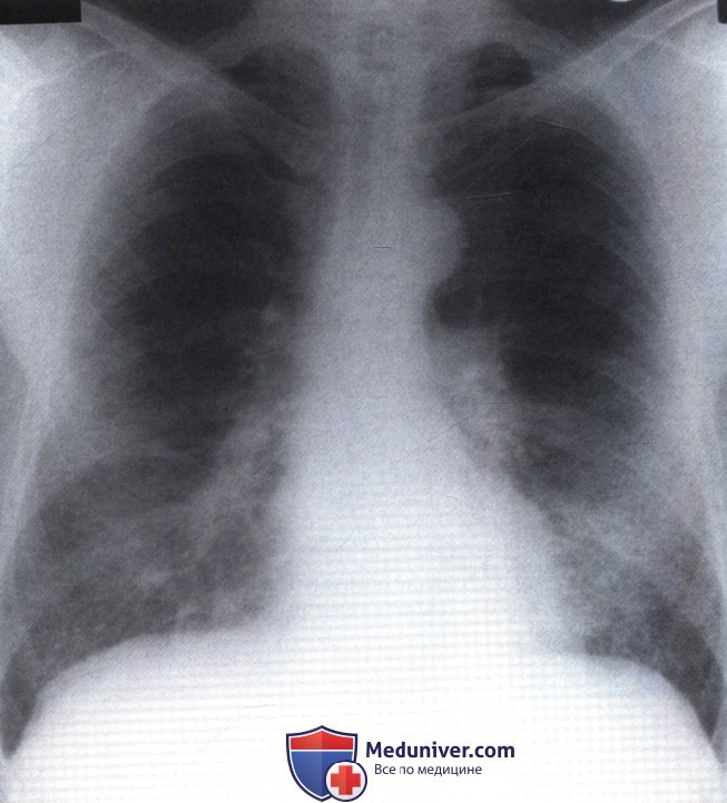 Рентгенограмма с затемнением легочных полей в базальных отделах с обеих сторон при фиброзирующем альвеолите