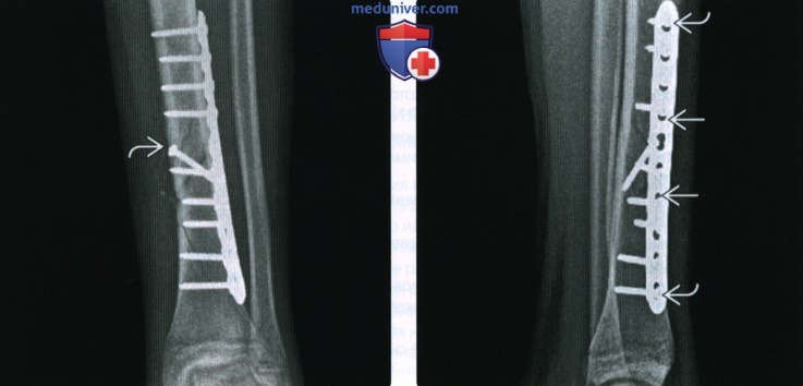 Рентгенограмма при фиксации кости пластинами
