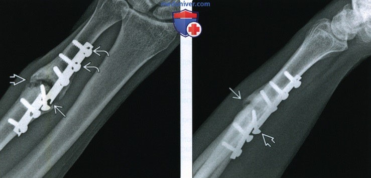Рентгенограмма при фиксации кости пластинами