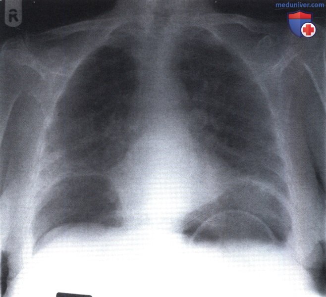 Рентгенограмма с двусторонним скоплением газа в поддиафрагмальном пространстве