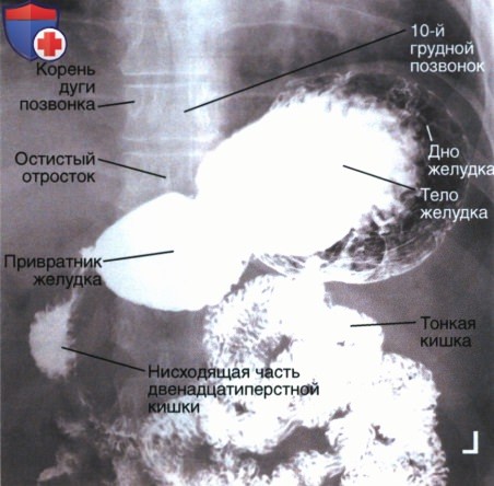 Рентгенограмма желудка и двенадцатиперстной кишки в ЗП проекции