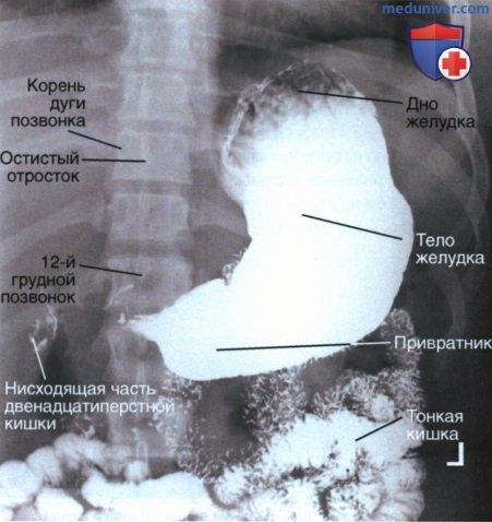 Укладка при рентгенограмме желудка и двенадцатиперстной кишки в ЗП проекции
