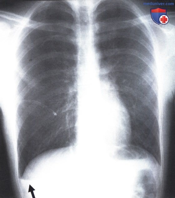 Рентгеновский снимок с просветлением легочного поля при гидропневмотораксе