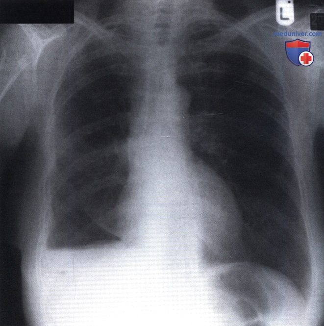 Рентгенограмма с гидропневмотораксом после нижней лобэктомии справа
