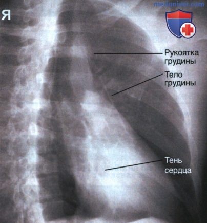 Рентгенограмма грудины в косой ЗП проекции