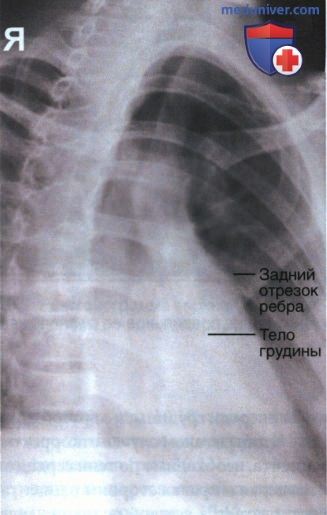 Рентгенограмма грудины в косой ЗП проекции