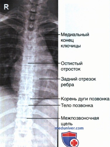 Укладка при рентгенограмме грудных позвонков в ПЗ проекции