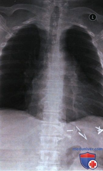Рентгенограмма грудных позвонков в ПЗ проекции