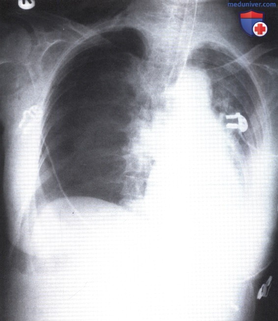 Рентгеновский снимок с патологическим просветлением правого легочного поля при пневмотораксе