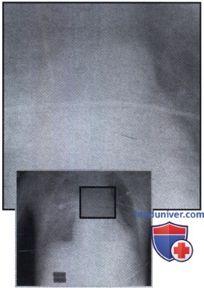 Рентгенограмма с затемнением в правом легком при эндотрахеальной интубации