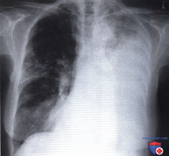 Рентгенограмма с консолидацией легочной ткани с сохранением просветов бронхов при раке