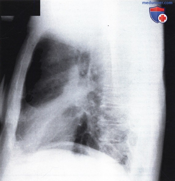 Рентгеновский снимок с консолидацией легочной ткани в язычковых сегментах