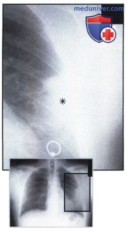 Рентгеновский снимок с консолидацией легочной ткани слева при пневмонии
