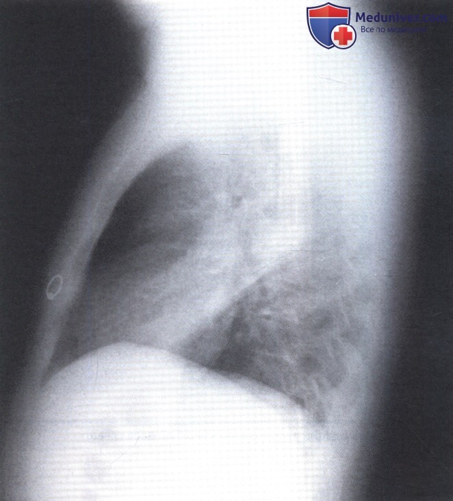 Рентгенограмма с областью консолидации в верхней доле слева