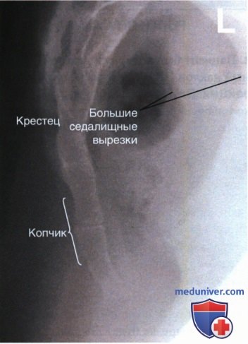 Укладка при рентгенограмме копчика в боковой проекции