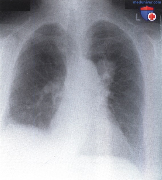 Рентгенограмма с деформацией корня левого легкого при раке