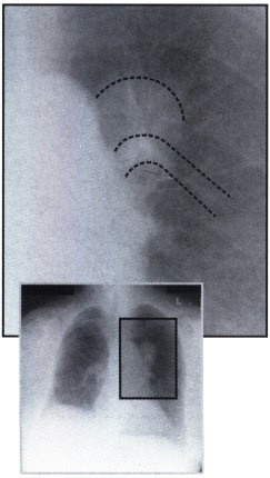 Рентгенограмма с деформацией корня левого легкого при раке