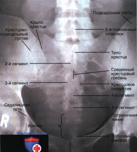 Укладка при рентгенограмме крестца в аксиальной ПЗ проекции
