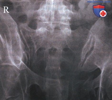 Укладка при рентгенограмме крестцово-подвздошных суставов в аксиальной ПЗ проекции
