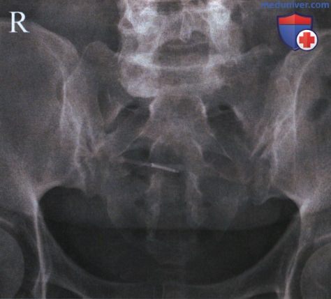 Укладка при рентгенограмме крестцово-подвздошных суставов в аксиальной ПЗ проекции
