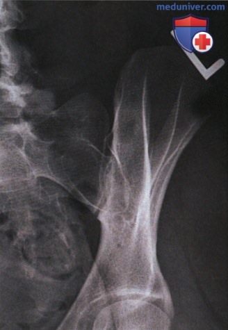Рентгенограмма крестцово-подвздошных суставов в косой ПЗ проекции
