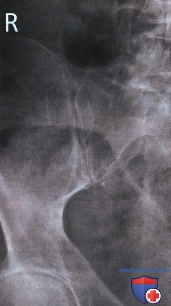 Рентгенограмма крестцово-подвздошных суставов в косой ПЗ проекции