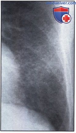 Рентгенограмма с затемненными легкими при криптогенном фиброзирующем альвеолите