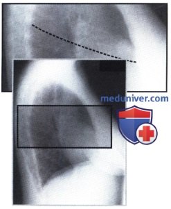 Рентгеновский снимок с круглой тенью (монетовидным образованием) в легком