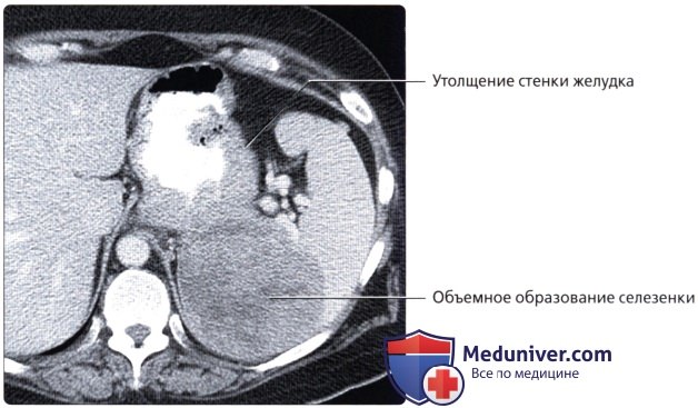 Лучевая анатомия (рентген, КТ анатомия) желудка и двенадцатиперстной кишки