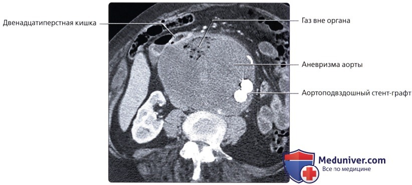 Лучевая анатомия (рентген, КТ анатомия) желудка и двенадцатиперстной кишки
