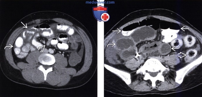 Рентгенограмма, КТ, ангиограмма при ишемическом энтерите