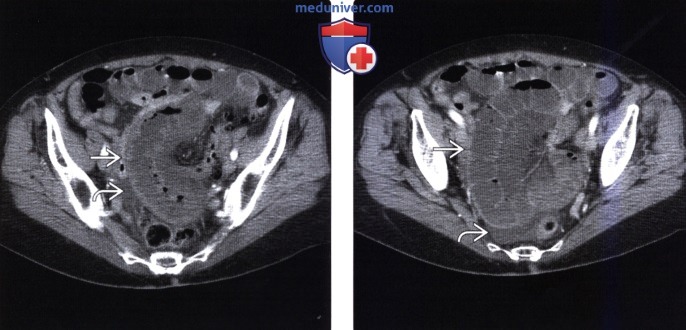 Рентгенограмма, КТ, ангиограмма при ишемическом энтерите