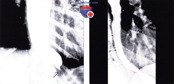 Рентгенограмма, КТ при ахалазии кардиального отдела пищевода