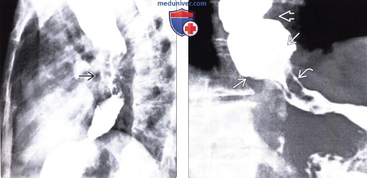 Рентгенограмма, КТ при ахалазии кардиального отдела пищевода