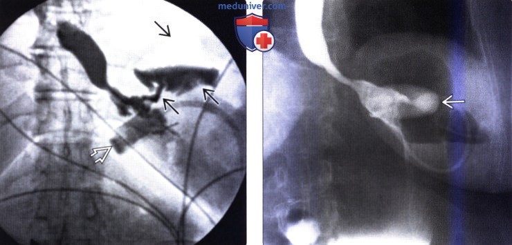 Рентгенограмма, КТ после операции на желудке с целью снижения веса (бариатрической операции)