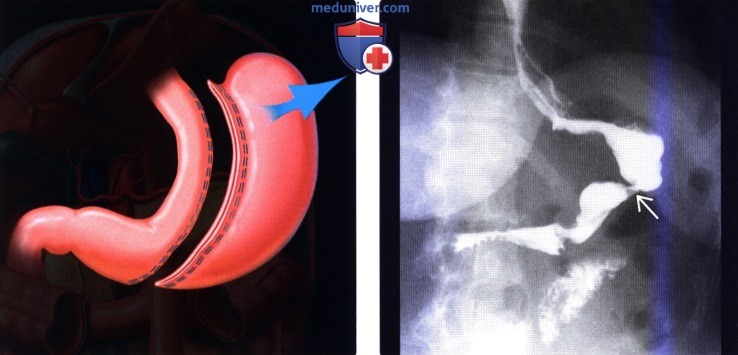 Рентгенограмма, КТ после операции на желудке с целью снижения веса (бариатрической операции)
